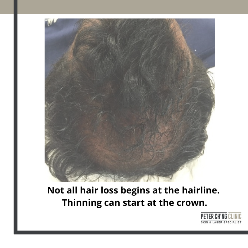 How Do I Know If I m Losing My Hair 4 Signs of Hair Loss Peter